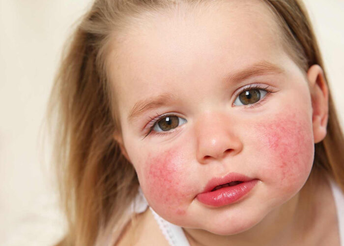 DERMATITIS DEL RECIÉN NACIDO Y LACTANTE