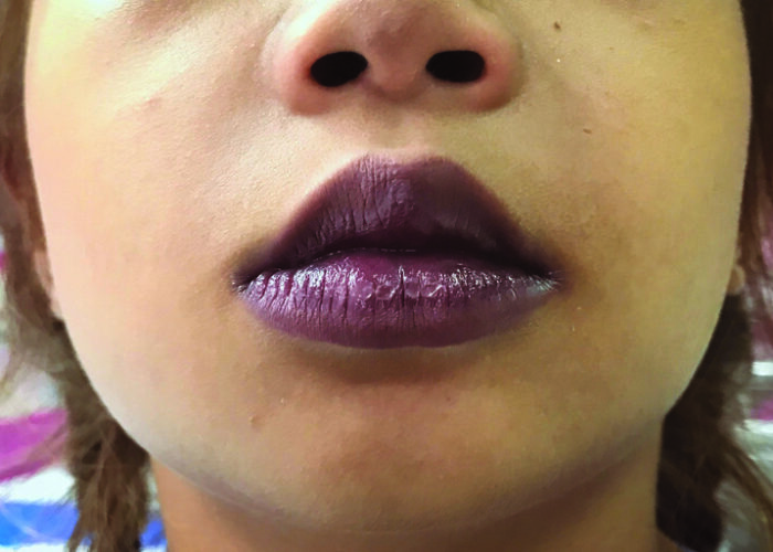 Cyanosis with refractory hypoxemia: a case report