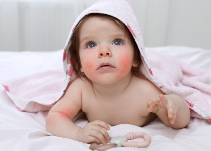 Dermatitis atópica