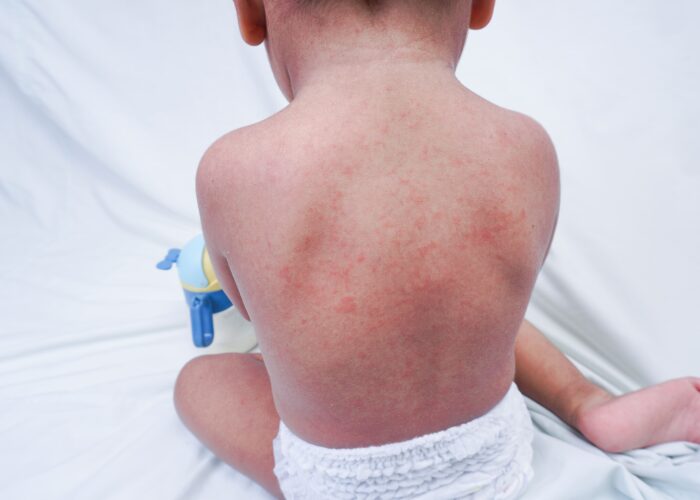 Urticaria