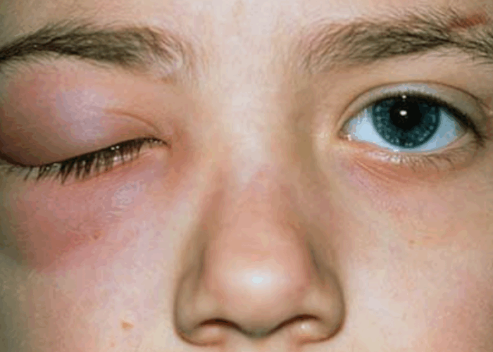 Celulitis facial odontogénica